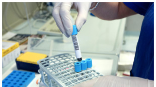 Anemia da tumori del sangue, nuova molecola riduce trasfusioni